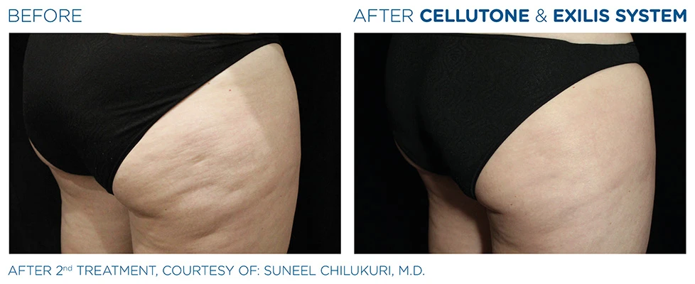 Chiropractic Bloomington IL Cellutone Before and After Patient 2